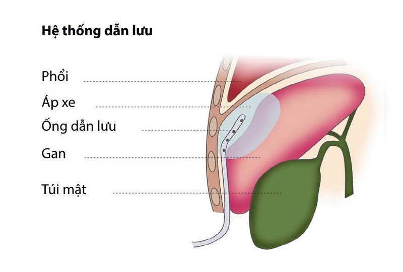 Dẫn lưu áp xe qua da là một kỹ thuật mới và là phương pháp đang được sử dụng nhiêu nhất